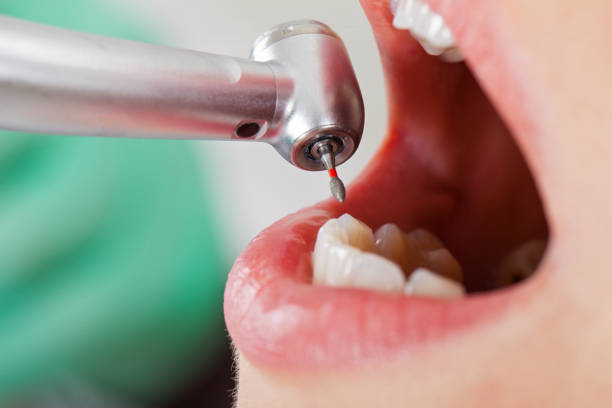 Best Root Canal Emergency Dentist  in Tucker, GA